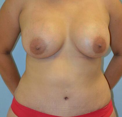 4_After_TT_Muscle_Plication_lipo_and_Breast_Aug_FInal__1-420x571