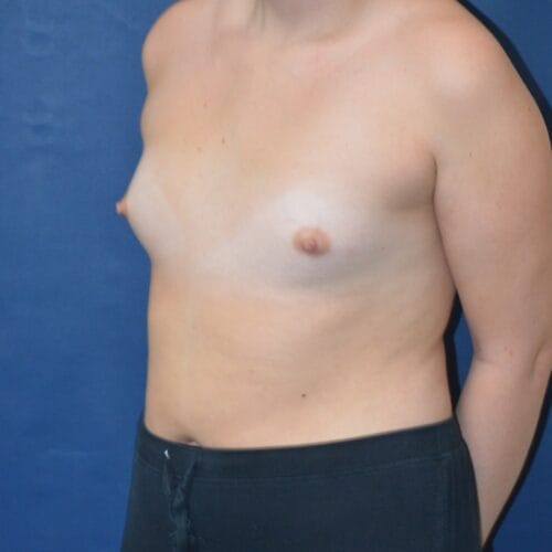 Before-2-18-21-24-YO-F-Breast-Augmenation-Silicone-and-Lipo-suction-to-the-axilla-5