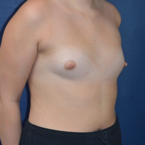 Before-2-18-21-24-YO-F-Breast-Augmenation-Silicone-and-Lipo-suction-to-the-axilla-6-e1679665612357