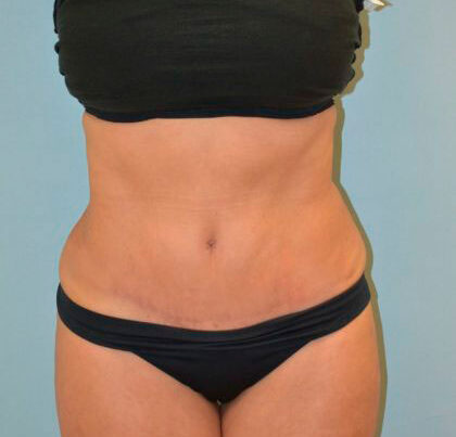 before_after_md-42138-1745966-after-1647368248494e1-420x632-1