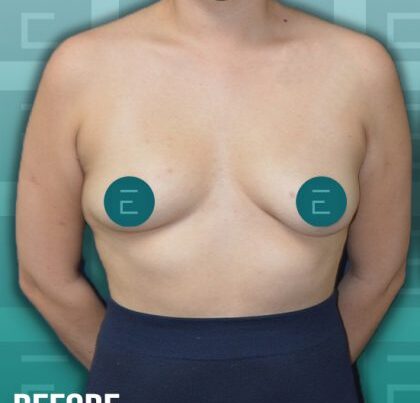 breastaug-copy-420x463