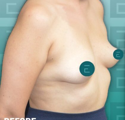 breastaug2-copy-420x469