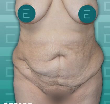 esth2-copy-420x476-1