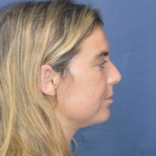 After-5-13-21-27-YO-Female-Liposuction-to-chin-8-664x1024