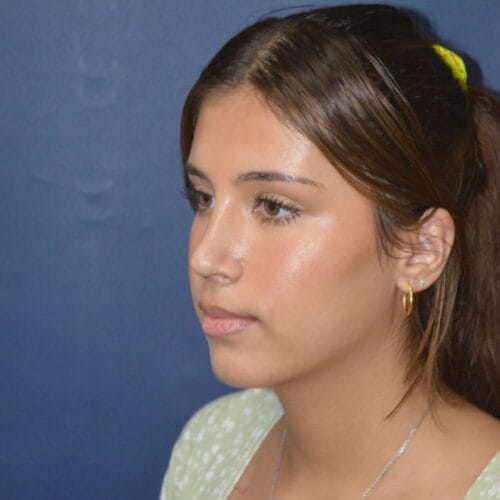 After-8-11-22-20-YO-F-Rhinoplasty-3-1362x2048