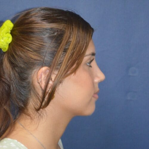 After-8-11-22-20-YO-F-Rhinoplasty-5-1431x2048