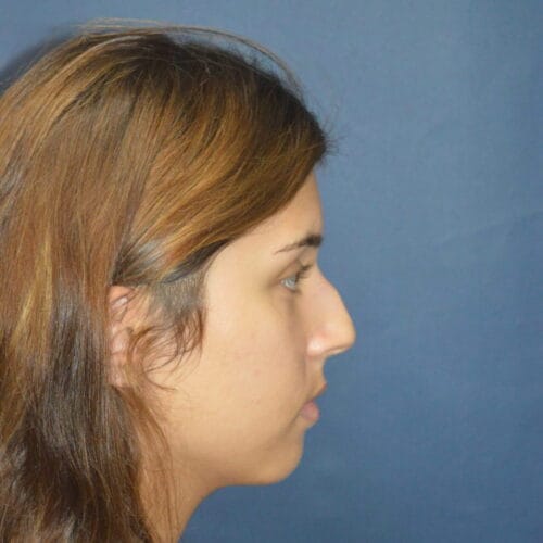 Before-7-25-22-20-YO-F-Rhinoplasty-3-1362x2048
