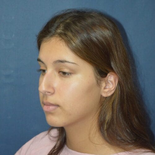 Before-7-25-22-20-YO-F-Rhinoplasty-6-1482x2048
