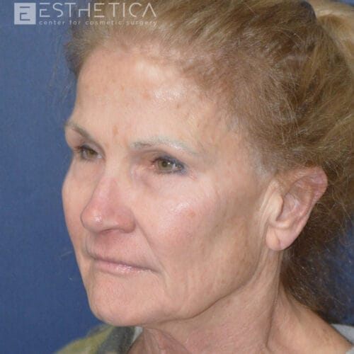 Lower-facelift-1-before-2
