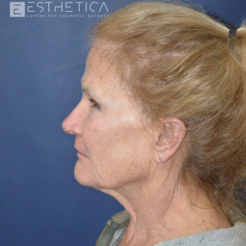 Lower-facelift-1-before-3
