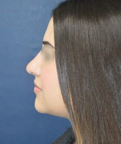 before_after_md-42138-1888026-after-1674167272a4147_2-420x680