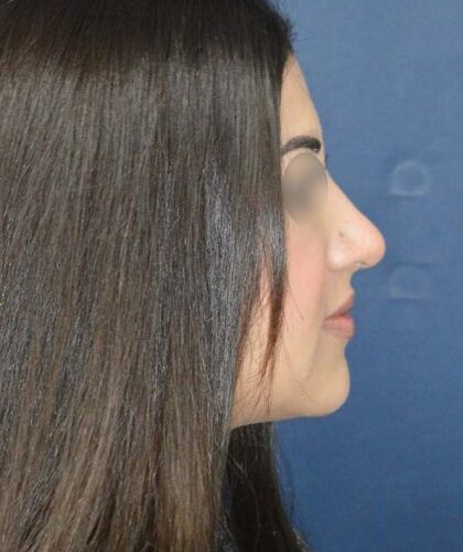 before_after_md-42138-1888026-after-167416727437254_2-420x705