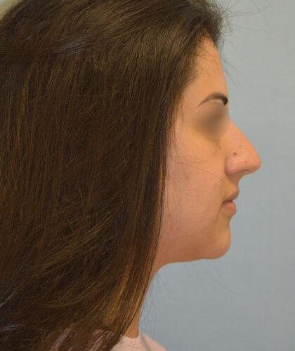 before_after_md-42138-1888026-before-1654725850cd3fa_2-420x669