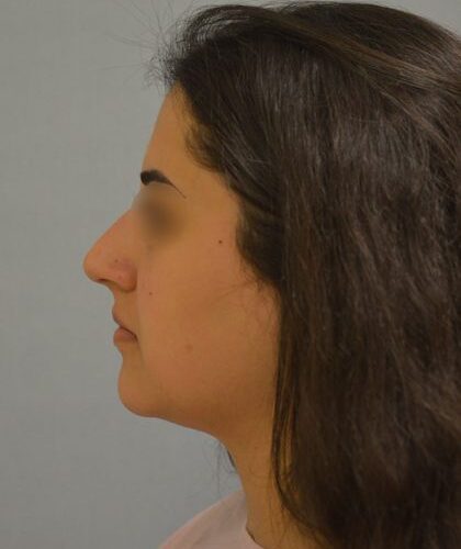 before_after_md-42138-1888026-before-1654725852fe7ea_1-420x641