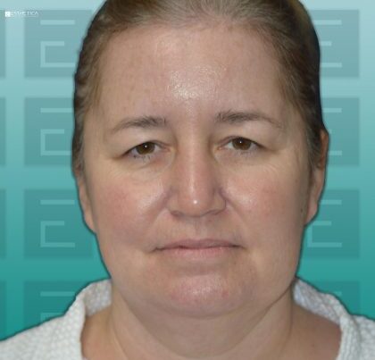 c1-b1-facelift-necklift-browlift-bleph-420x420