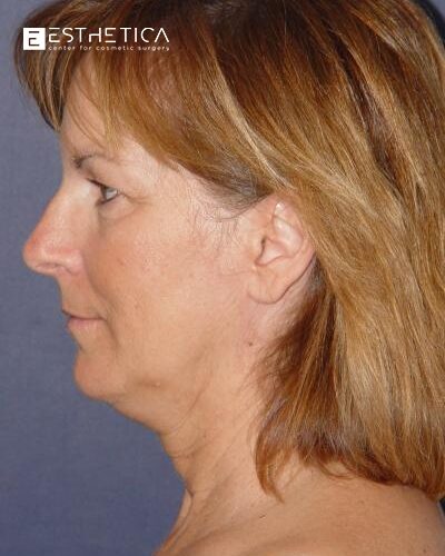 c2-b3-browlift
