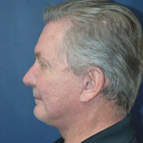 estheticasandiego-ba-2023-chin-2-after-1