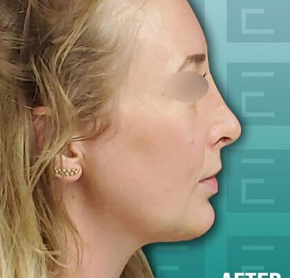 newportrhino-420x464