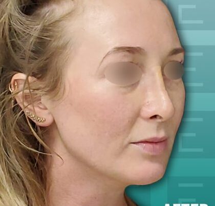 newportrhino2-420x472