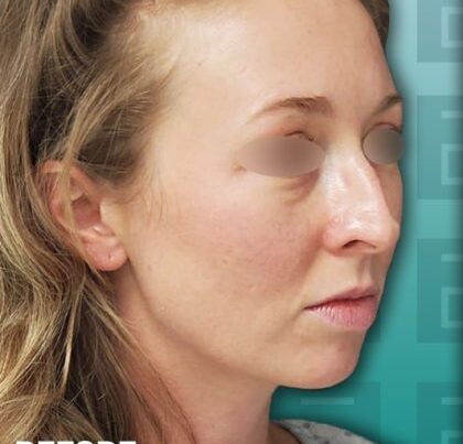 newportrhino2-copy-420x479