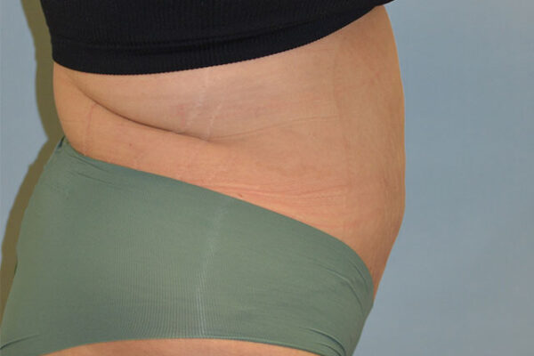 27yo__FemaleLiposuction-of-the-abdomen,-flanks,-and-abdominoplasty-with-muscle-plication__after-1