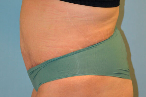 27yo__FemaleLiposuction-of-the-abdomen,-flanks,-and-abdominoplasty-with-muscle-plication__after-3