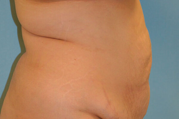 27yo__FemaleLiposuction-of-the-abdomen,-flanks,-and-abdominoplasty-with-muscle-plication__before-1