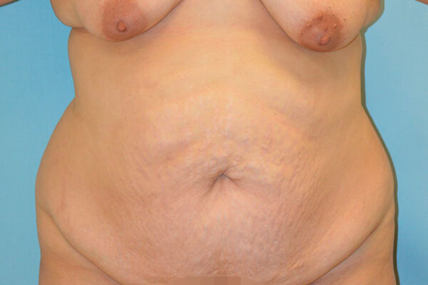 27yo__FemaleLiposuction-of-the-abdomen,-flanks,-and-abdominoplasty-with-muscle-plication__before-2