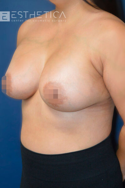 34yo__Female-Breast-augmentation-with-silicone-implants-and-liposuction-of-the-axilla__after-3