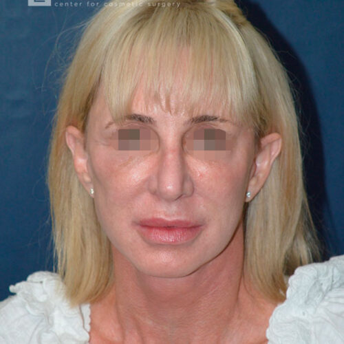 54yo__Female,--Lower-facelift,-upper-bleph-and-natural-fat-transfer-to-the-face-and-hands__after-1