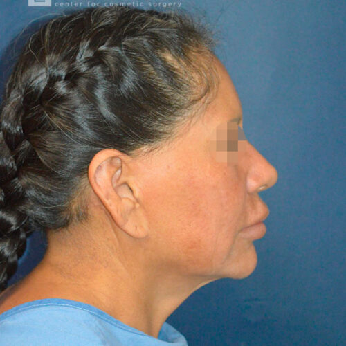60yo__Female-Complete-Lower-facelift__before-3