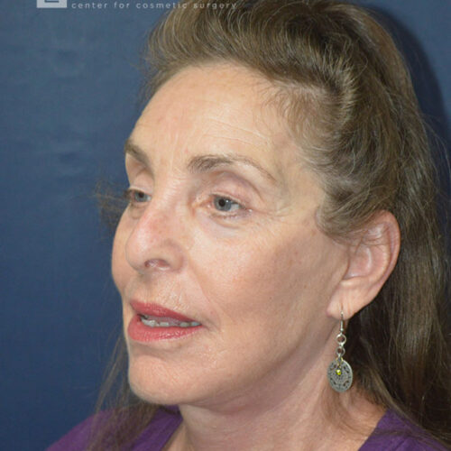 71yo__Female-Lower-facelift,-upper-and-lower-blepharoplasty,-fat-transfer-to-the-face,-CO2-laser-around-mouth-and-eyes__after-2