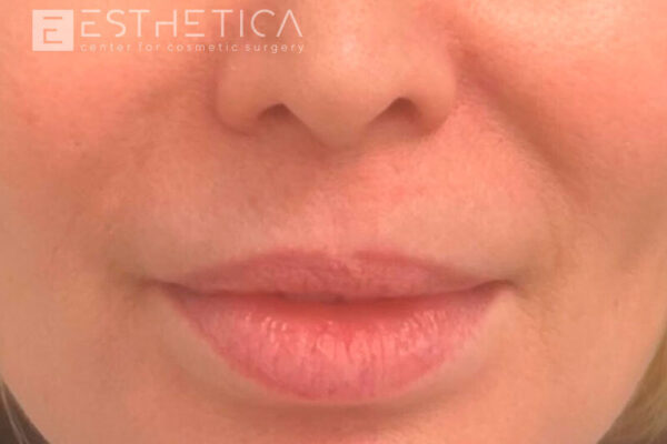 esthetica__before-eafter__24-09__2
